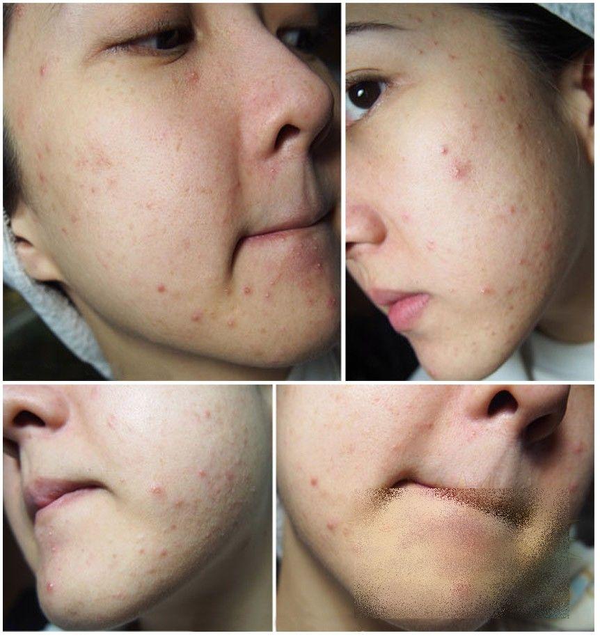 Ce i s-a întâmplat acestei fete frumoase după un simplu TRATAMENT COSMETIC. &quot;Sunt un MONSTRU. Nu mai pot ieşi din casă&quot; 212273