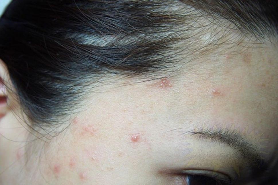 Ce i s-a întâmplat acestei fete frumoase după un simplu TRATAMENT COSMETIC. &quot;Sunt un MONSTRU. Nu mai pot ieşi din casă&quot; 212274