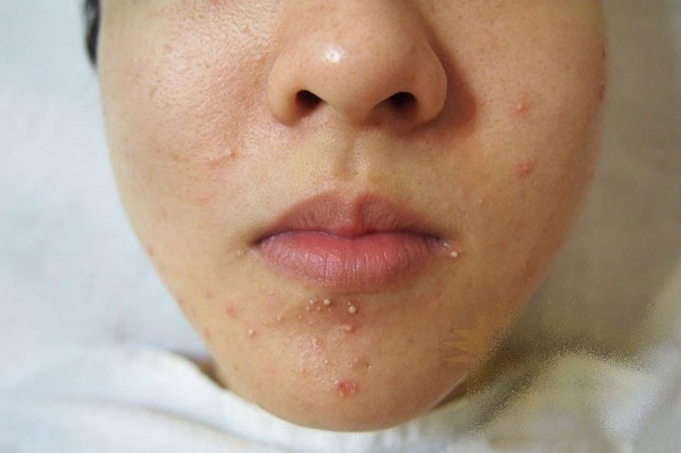 Ce i s-a întâmplat acestei fete frumoase după un simplu TRATAMENT COSMETIC. &quot;Sunt un MONSTRU. Nu mai pot ieşi din casă&quot; 212275