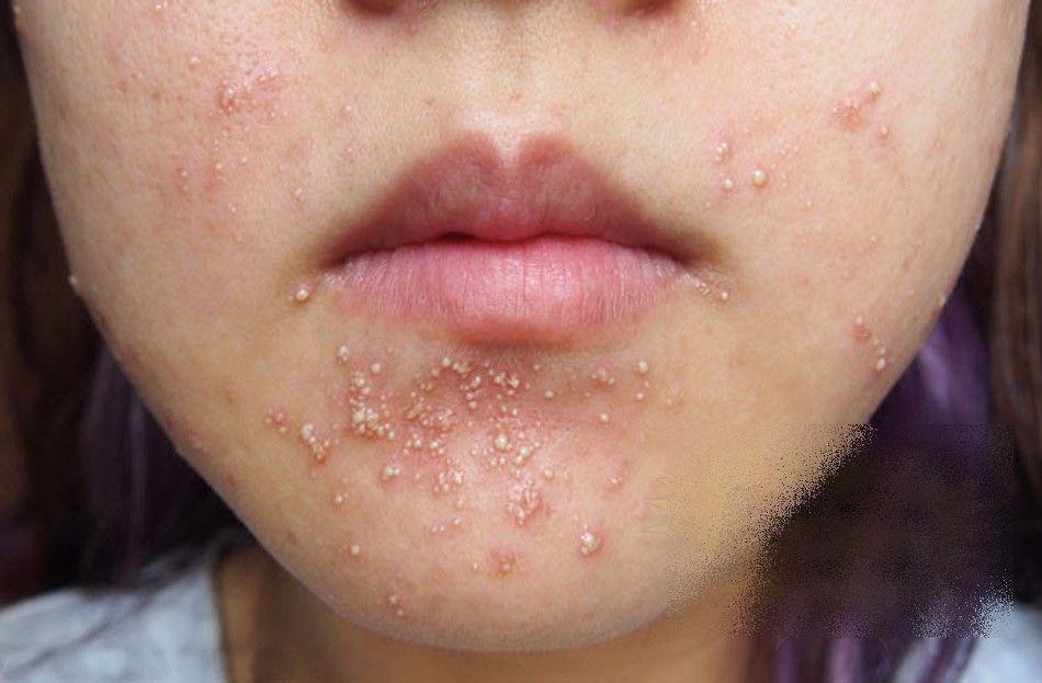 Ce i s-a întâmplat acestei fete frumoase după un simplu TRATAMENT COSMETIC. &quot;Sunt un MONSTRU. Nu mai pot ieşi din casă&quot; 212276