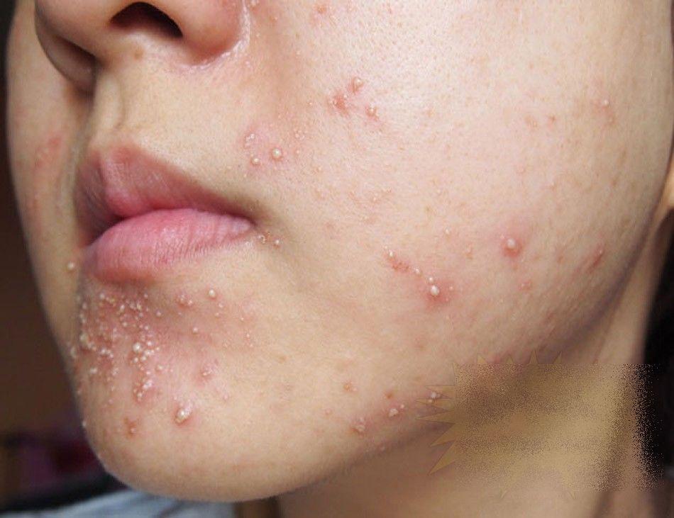 Ce i s-a întâmplat acestei fete frumoase după un simplu TRATAMENT COSMETIC. &quot;Sunt un MONSTRU. Nu mai pot ieşi din casă&quot; 212277