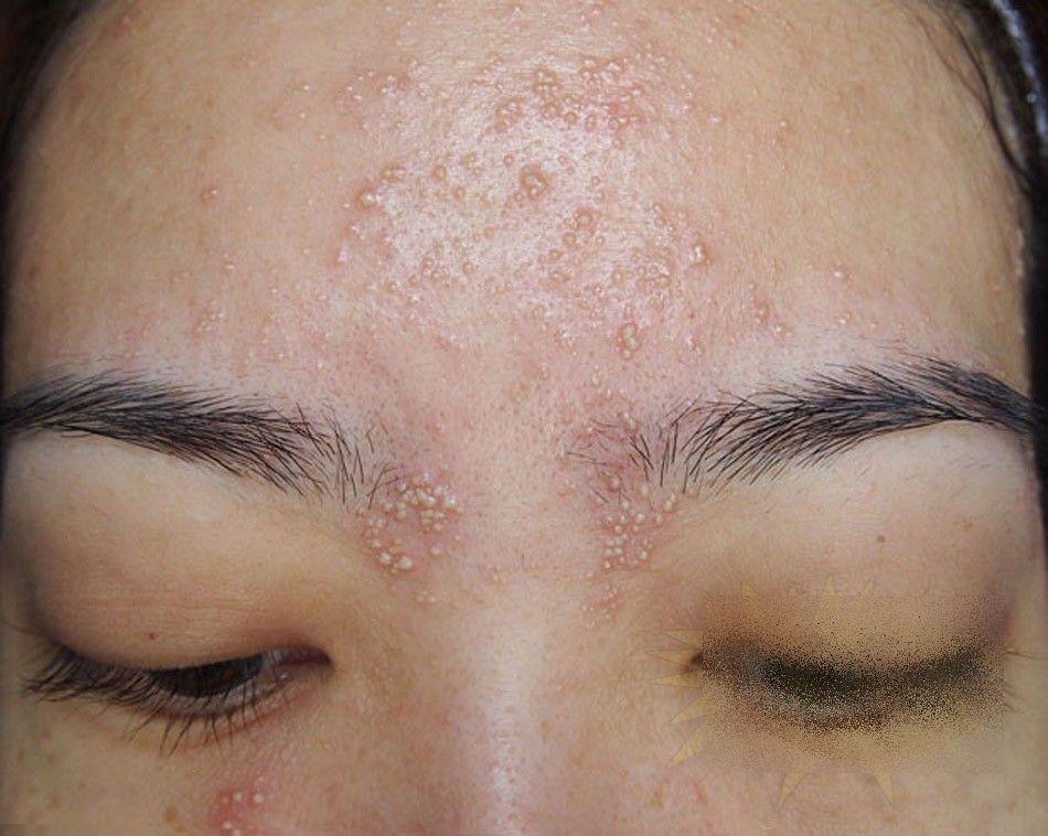 Ce i s-a întâmplat acestei fete frumoase după un simplu TRATAMENT COSMETIC. &quot;Sunt un MONSTRU. Nu mai pot ieşi din casă&quot; 212278