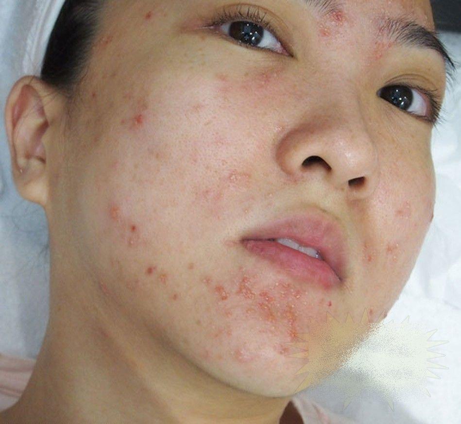 Ce i s-a întâmplat acestei fete frumoase după un simplu TRATAMENT COSMETIC. &quot;Sunt un MONSTRU. Nu mai pot ieşi din casă&quot; 212279