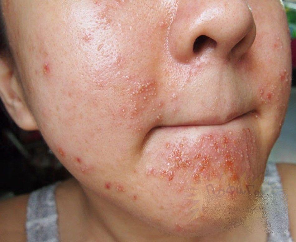 Ce i s-a întâmplat acestei fete frumoase după un simplu TRATAMENT COSMETIC. &quot;Sunt un MONSTRU. Nu mai pot ieşi din casă&quot; 212281