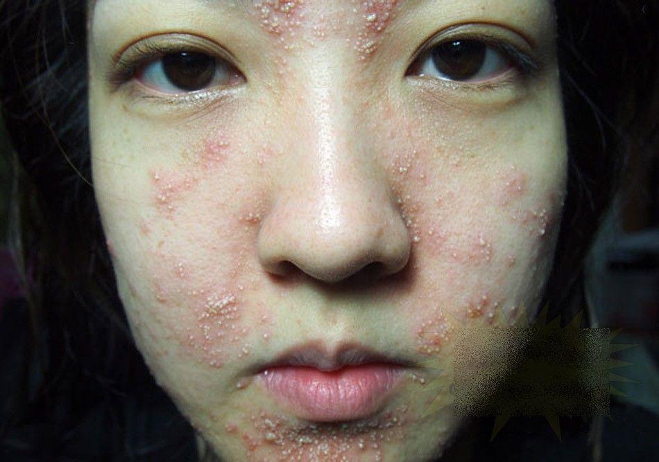 Ce i s-a întâmplat acestei fete frumoase după un simplu TRATAMENT COSMETIC. &quot;Sunt un MONSTRU. Nu mai pot ieşi din casă&quot; 212282