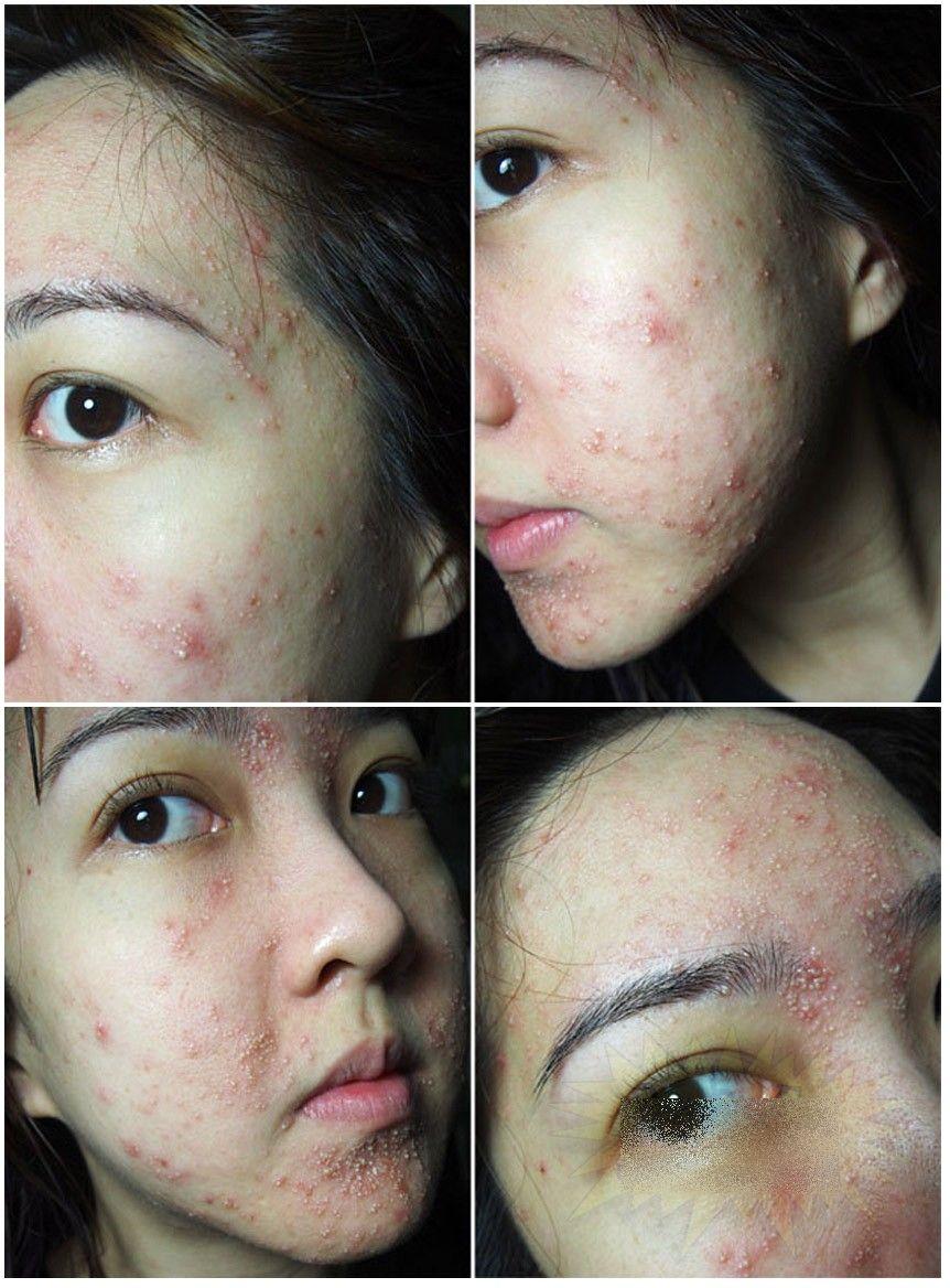 Ce i s-a întâmplat acestei fete frumoase după un simplu TRATAMENT COSMETIC. &quot;Sunt un MONSTRU. Nu mai pot ieşi din casă&quot; 212283