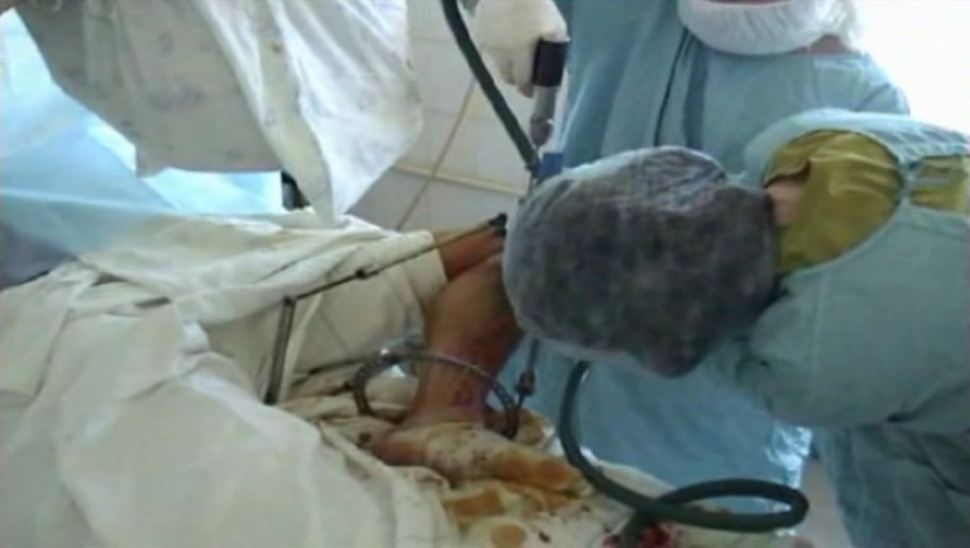 Scene de groază într-un spital din Chişinău. Copiii sunt operaţi cu BORMAŞINI industriale şi cleşti ruginiţi