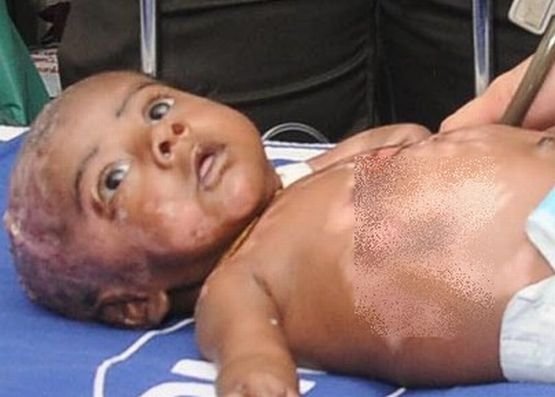 Cazul care i-a bulversat pe medicii din India: Acest bebeluş se transformă într-o torţă umană de fiecare dată când transpiră