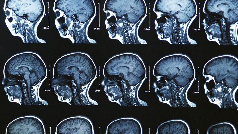 BOALA de care suferă milioane de români poate afecta iremediabil creierul. Au descoperit asta acum