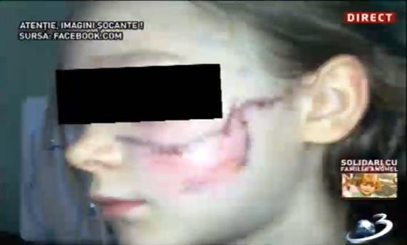 Imagini şocante! Oameni muşcaţi de câini maidanezi 224347