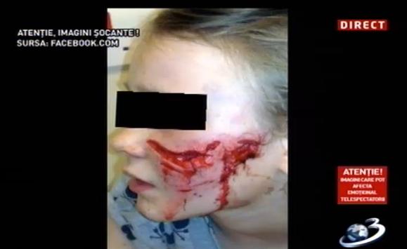 Imagini şocante! Oameni muşcaţi de câini maidanezi 224349