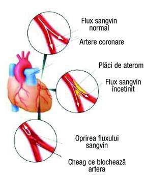 Simptomele unui infarct - cum să recunoști apariția infarctului miocardic