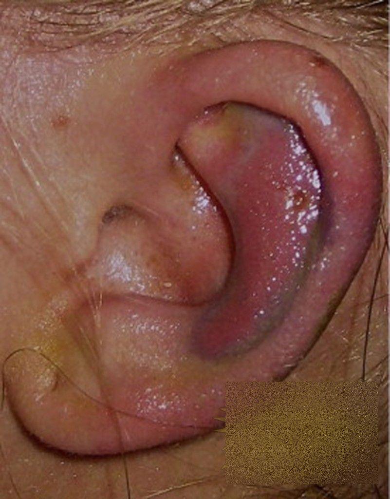 Această tânără a trecut prin coşmarul vieţii ei, după o vizită în Italia. Cum arată după ce a fost muşcată de un păianjen 236073