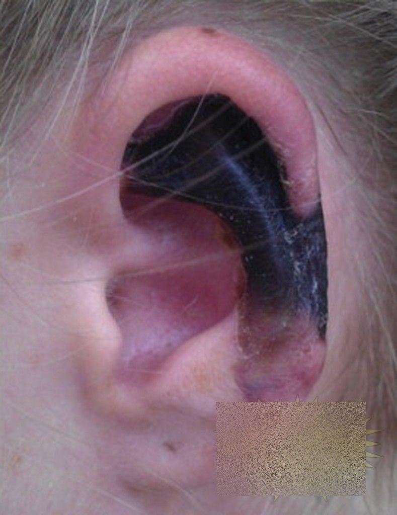 Această tânără a trecut prin coşmarul vieţii ei, după o vizită în Italia. Cum arată după ce a fost muşcată de un păianjen 236075