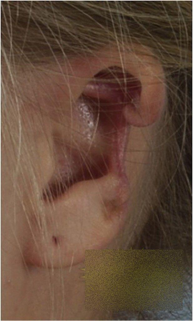 Această tânără a trecut prin coşmarul vieţii ei, după o vizită în Italia. Cum arată după ce a fost muşcată de un păianjen 236076