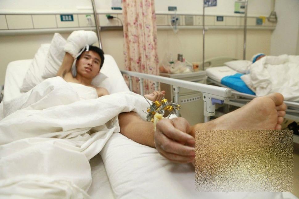 Acest caz a uluit lumea medicală. Ce i-a "crescut" acestui bărbat în PICIOR 239810