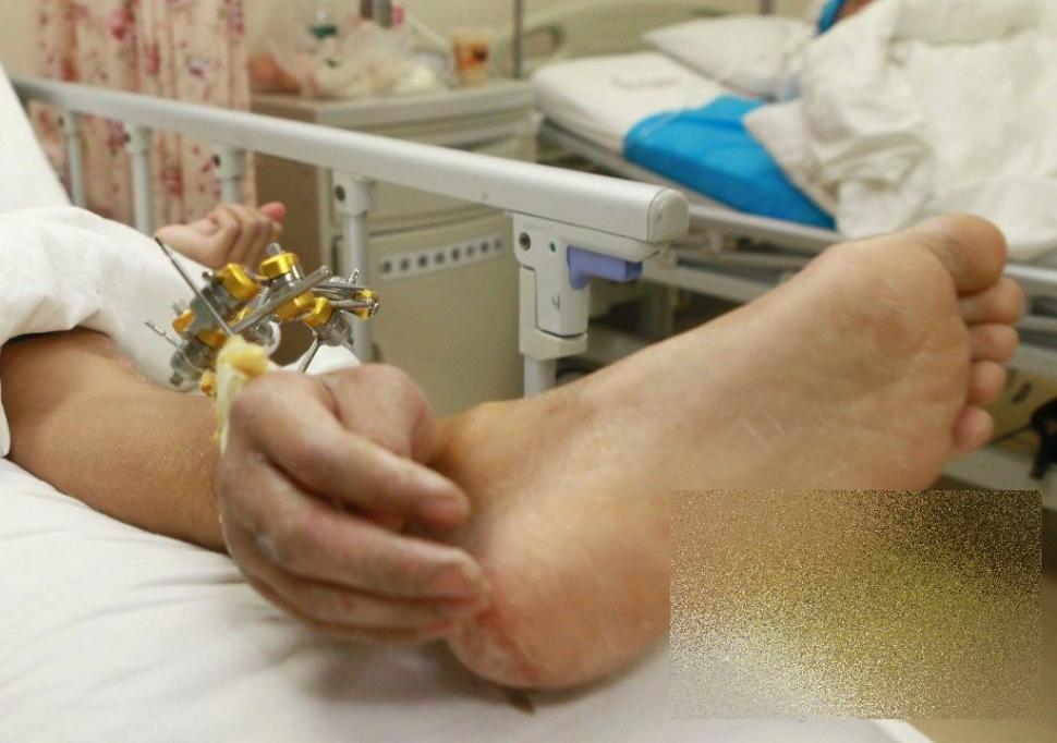 Acest caz a uluit lumea medicală. Ce i-a "crescut" acestui bărbat în PICIOR 239811