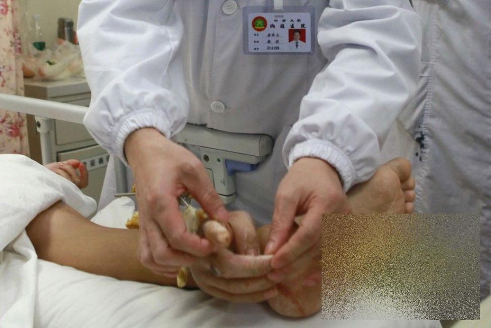 Acest caz a uluit lumea medicală. Ce i-a "crescut" acestui bărbat în PICIOR 239813