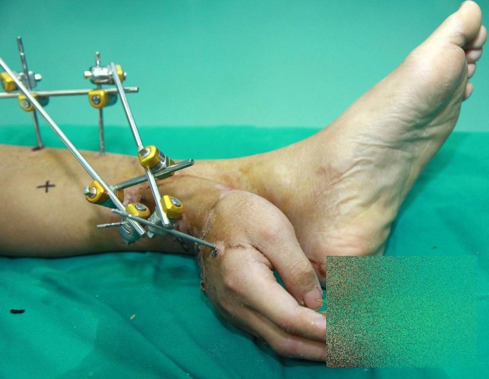 Acest caz a uluit lumea medicală. Ce i-a "crescut" acestui bărbat în PICIOR 239814