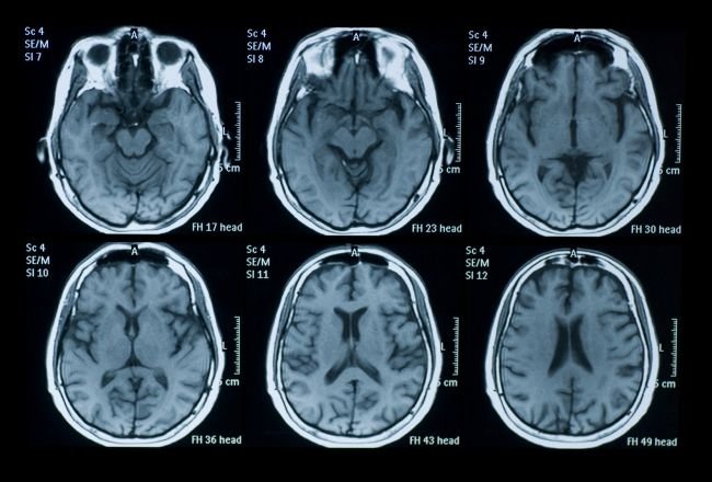Studiu: Marijuana poate afecta memoria şi ar putea chiar avea legătură cu schizofrenia