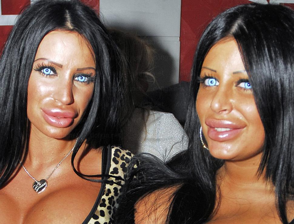 Li se spune "reginele siliconului". Cum arată fetele care nu mai au nicio expresie facială din cauza Botoxului 249040