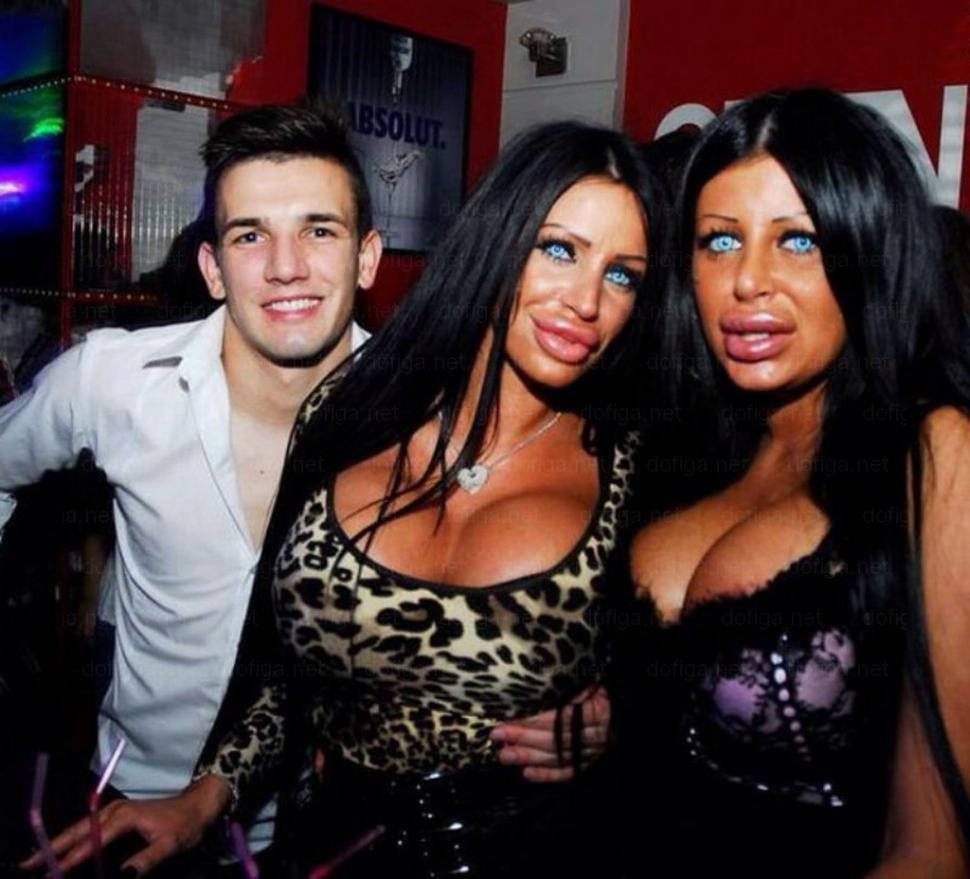 Li se spune "reginele siliconului". Cum arată fetele care nu mai au nicio expresie facială din cauza Botoxului 249043