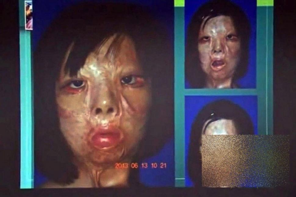 PREMIERĂ ISTORICĂ în lumea medicinei. Cum arată acum această tânără după operaţie 250184