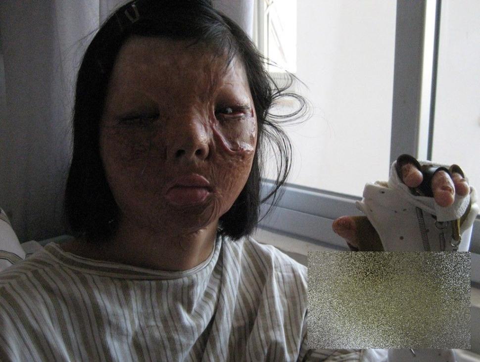 PREMIERĂ ISTORICĂ în lumea medicinei. Cum arată acum această tânără după operaţie 250185