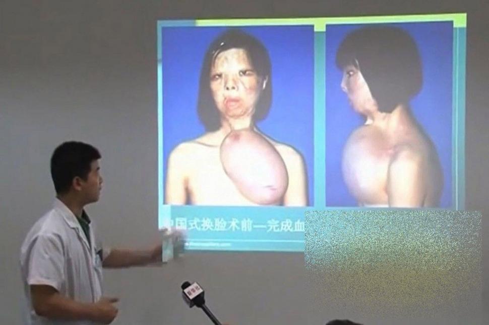 PREMIERĂ ISTORICĂ în lumea medicinei. Cum arată acum această tânără după operaţie 250187