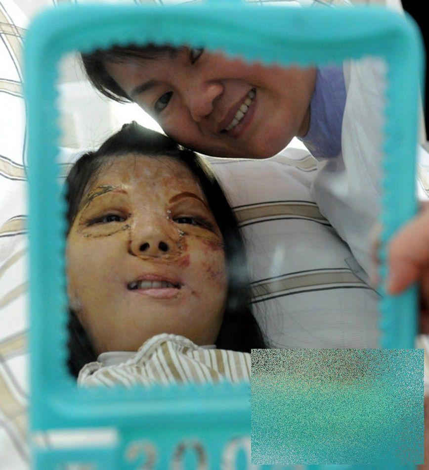 PREMIERĂ ISTORICĂ în lumea medicinei. Cum arată acum această tânără după operaţie 250191