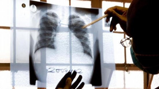 Aproximativ un milion de copii sunt afectaţi de tuberculoză în fiecare an la nivel mondial