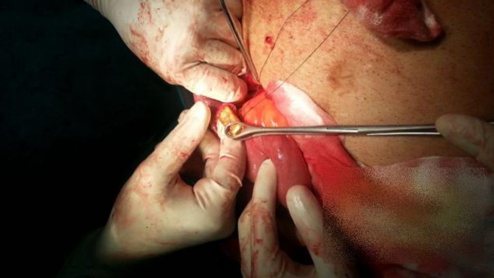 Ce au găsit chirurgii în STOMACUL unui om de afaceri. "N-am văzut în viaţa noastră aşa ceva" 256927