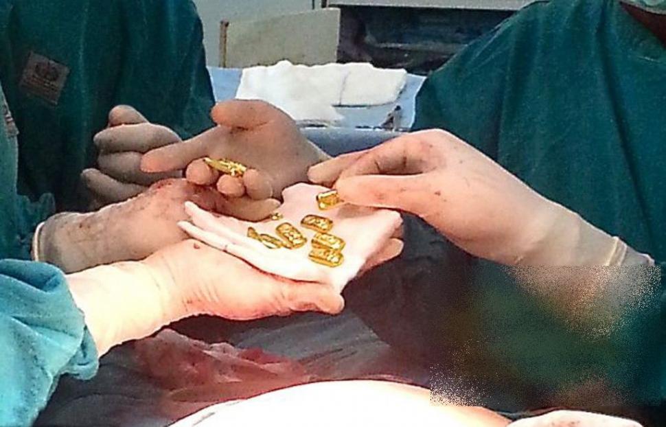 Ce au găsit chirurgii în STOMACUL unui om de afaceri. "N-am văzut în viaţa noastră aşa ceva" 256928