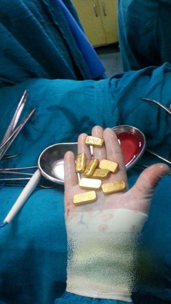 Ce au găsit chirurgii în STOMACUL unui om de afaceri. "N-am văzut în viaţa noastră aşa ceva" 256929