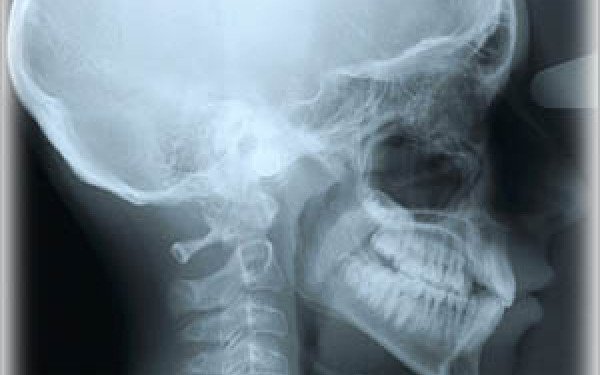 Radiografii încurcate la spitalul din Târgu Jiu. Un copil cu mâna fracturată a primit rezultatele unei analize la craniu