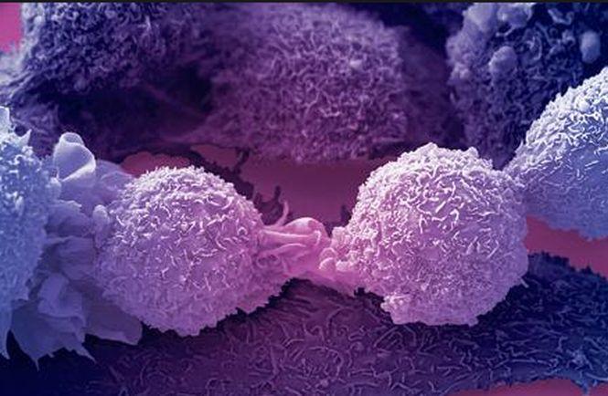 Studiu: Dubla mastectomie nu e indicată în cazul tuturor femeilor diagnosticate cu cancer la un singur sân