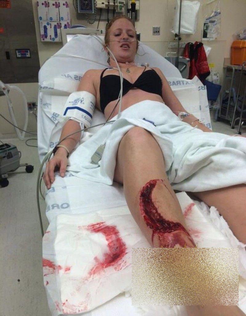 Este cea mai norocoasă femeie. Cum arată după ce a fost SFÂŞIATĂ de un RECHIN 262535