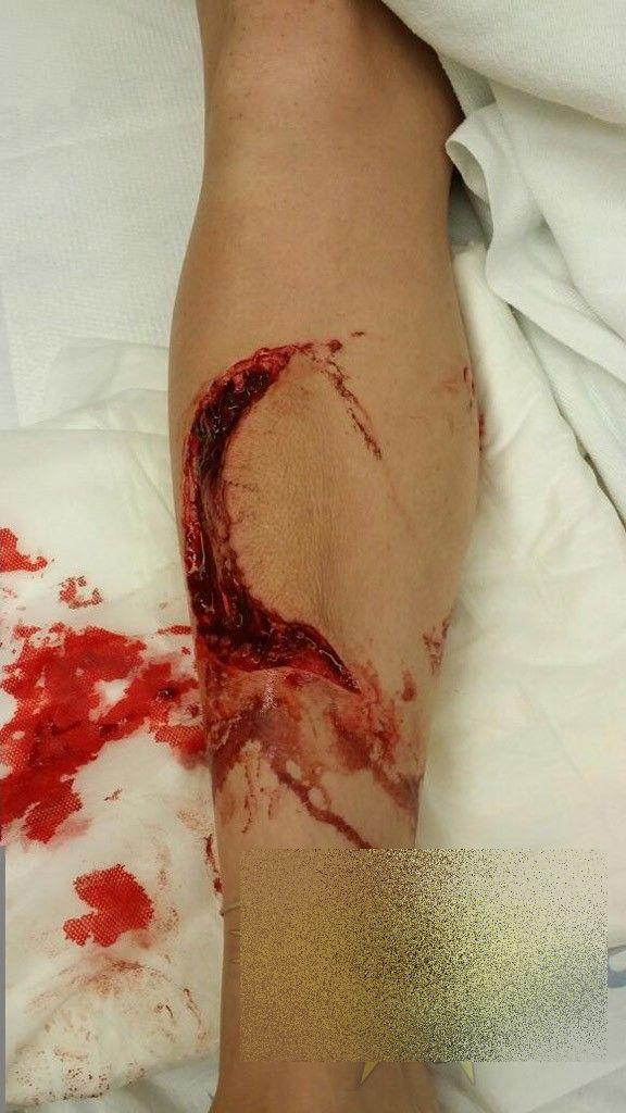 Este cea mai norocoasă femeie. Cum arată după ce a fost SFÂŞIATĂ de un RECHIN 262536