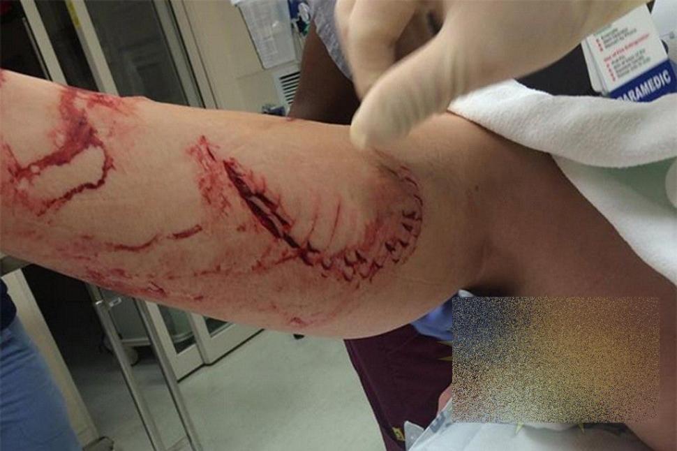 Este cea mai norocoasă femeie. Cum arată după ce a fost SFÂŞIATĂ de un RECHIN 262538