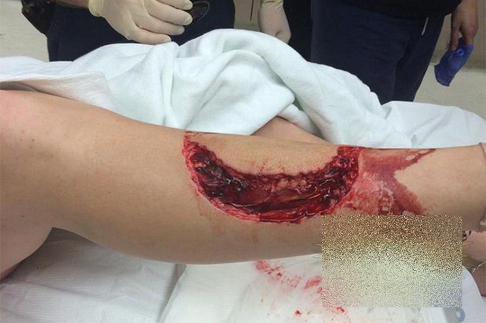 Este cea mai norocoasă femeie. Cum arată după ce a fost SFÂŞIATĂ de un RECHIN 262539