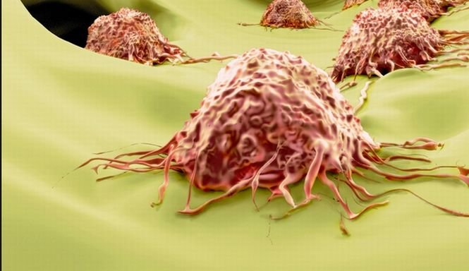 Descoperirea care ar putea revoluţiona tratamentul cancerului. Substanţa împiedică dezvoltarea metastazelor