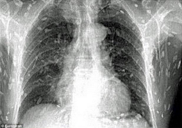 A ajuns la urgenţe cu dureri de stomac şi o senzaţie de mâncărime pe întreg corpul. Ce au descoperit medicii în corpul său i-a lăsat fără cuvinte 276895