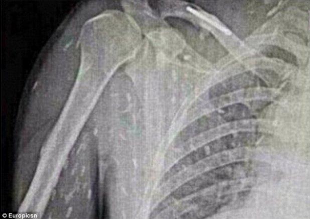 A ajuns la urgenţe cu dureri de stomac şi o senzaţie de mâncărime pe întreg corpul. Ce au descoperit medicii în corpul său i-a lăsat fără cuvinte 276897