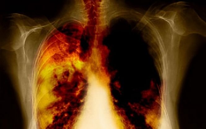 Cancerul pulmonar poate să rămână în stare latentă timp de două decenii
