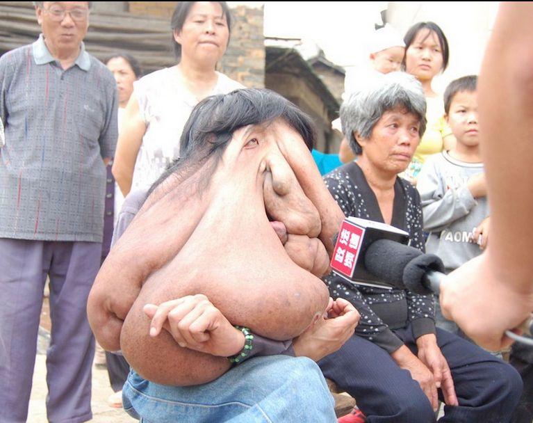 I se spune "omul elefant". Tumora lui cântărea 25 de kilograme, dar medicii au reuşit un miracol 279520