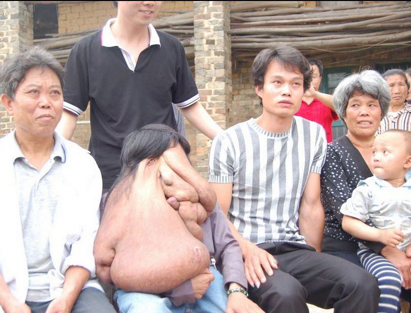 I se spune "omul elefant". Tumora lui cântărea 25 de kilograme, dar medicii au reuşit un miracol 279521