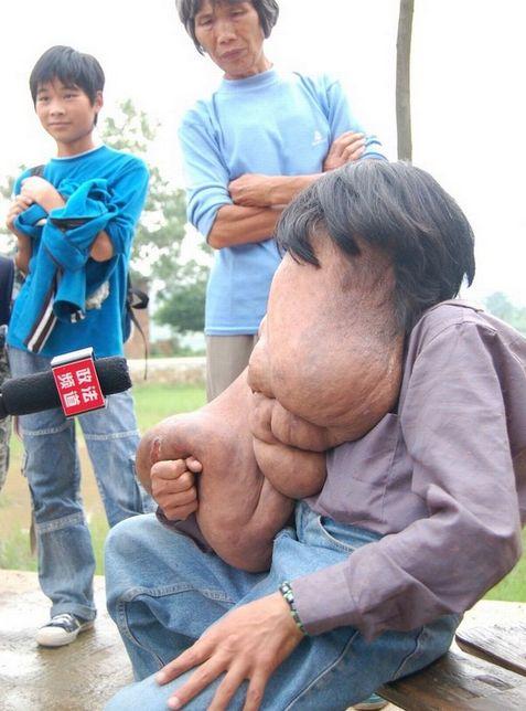 I se spune "omul elefant". Tumora lui cântărea 25 de kilograme, dar medicii au reuşit un miracol 279522