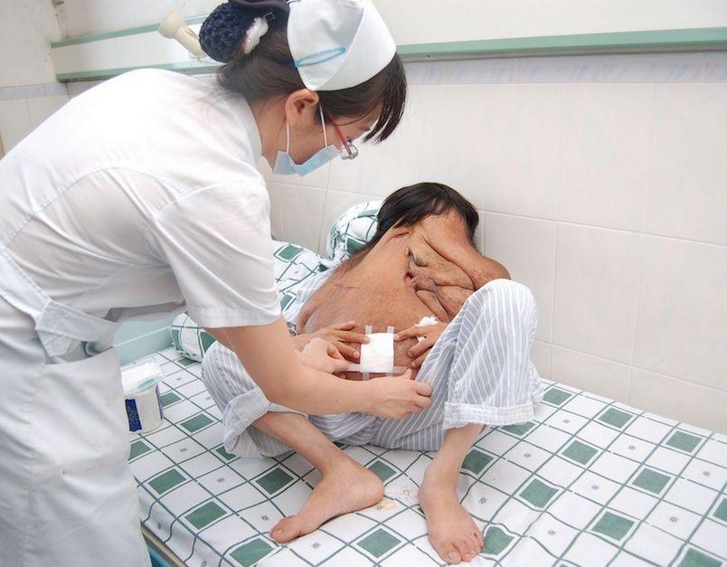 I se spune "omul elefant". Tumora lui cântărea 25 de kilograme, dar medicii au reuşit un miracol 279523