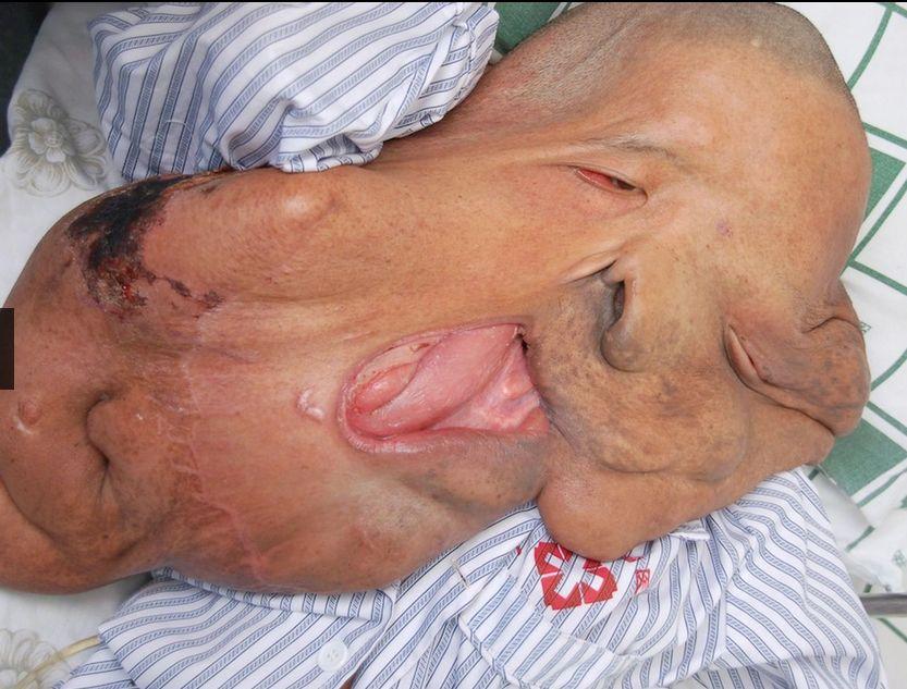 I se spune "omul elefant". Tumora lui cântărea 25 de kilograme, dar medicii au reuşit un miracol 279524