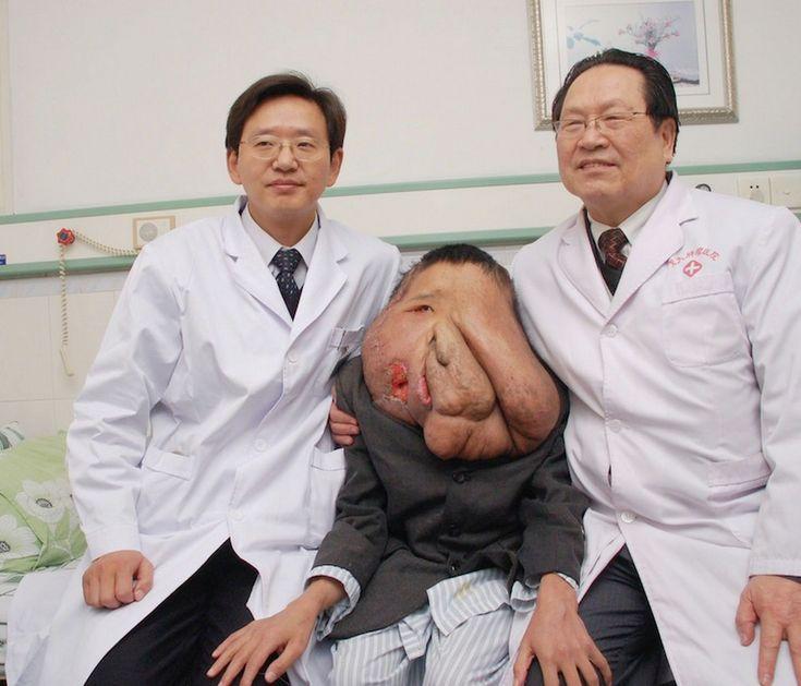 I se spune "omul elefant". Tumora lui cântărea 25 de kilograme, dar medicii au reuşit un miracol 279525